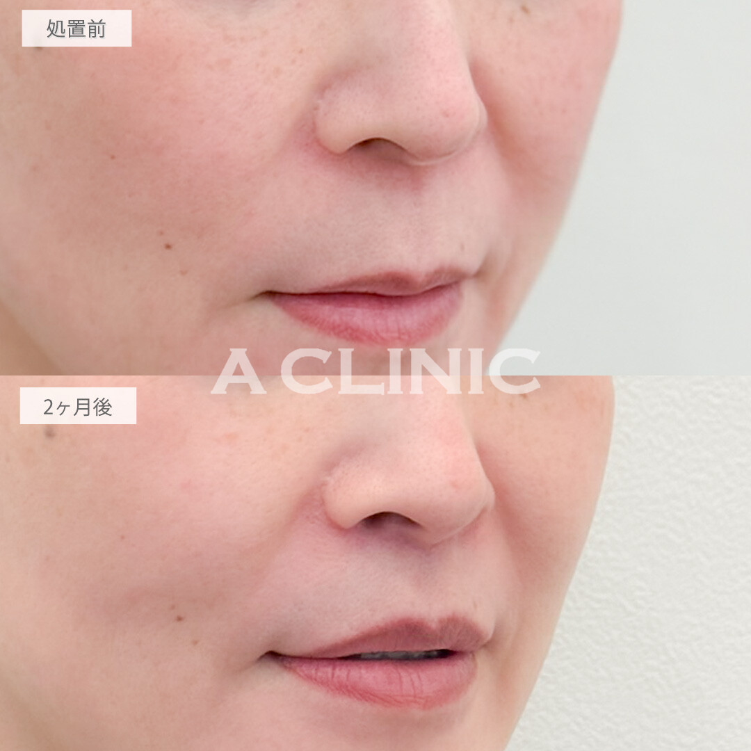 人中短縮術で老け顔に見えやすい長い人中も短くして若々しい口元へ！処置前と2ヶ月後の症例です(50代女性)