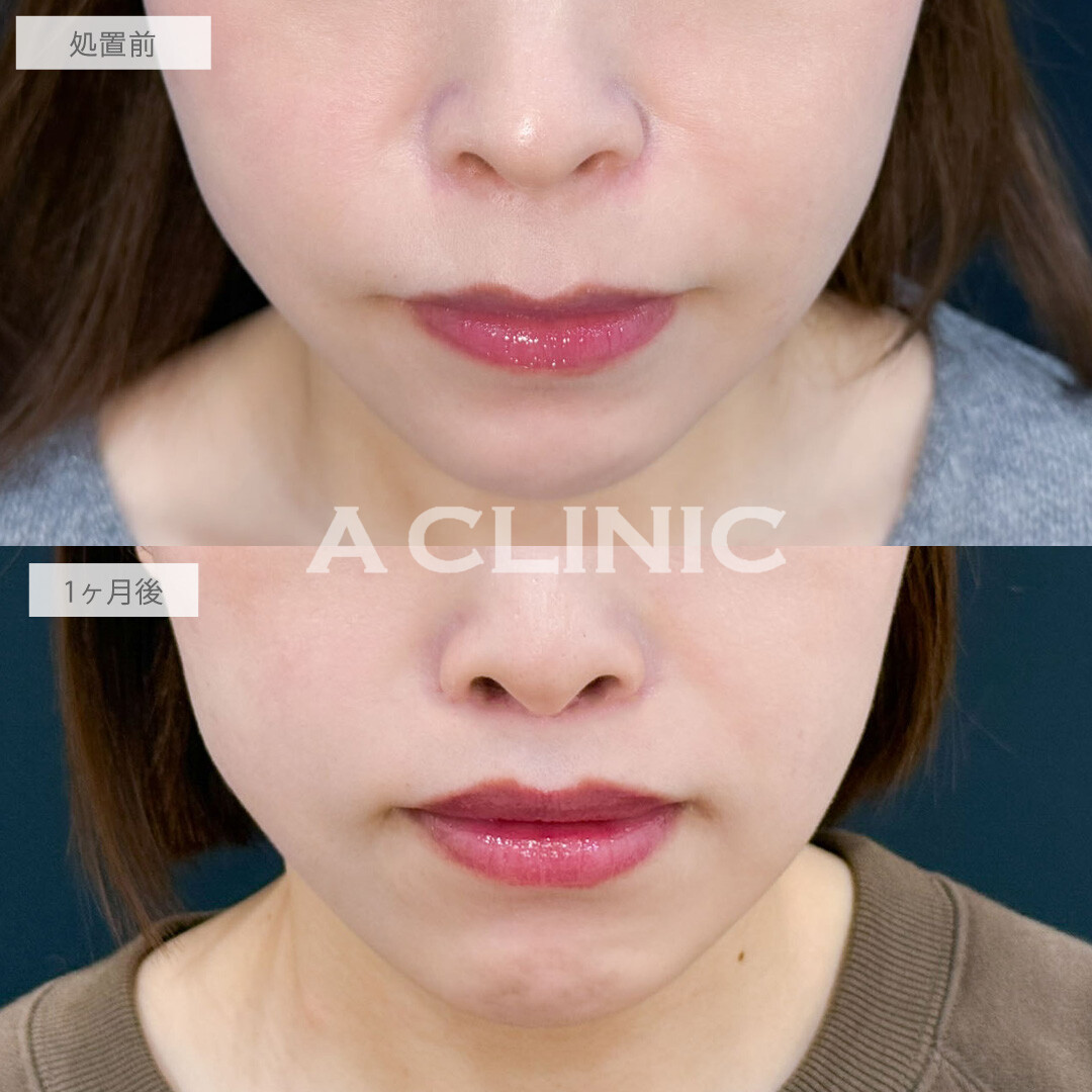 人中短縮術で間伸び感が出た人中を劇的に短縮し上向きCカールが際立つ理想のリップラインへ！こちら処置前と1か月後の症例です(30代女性)