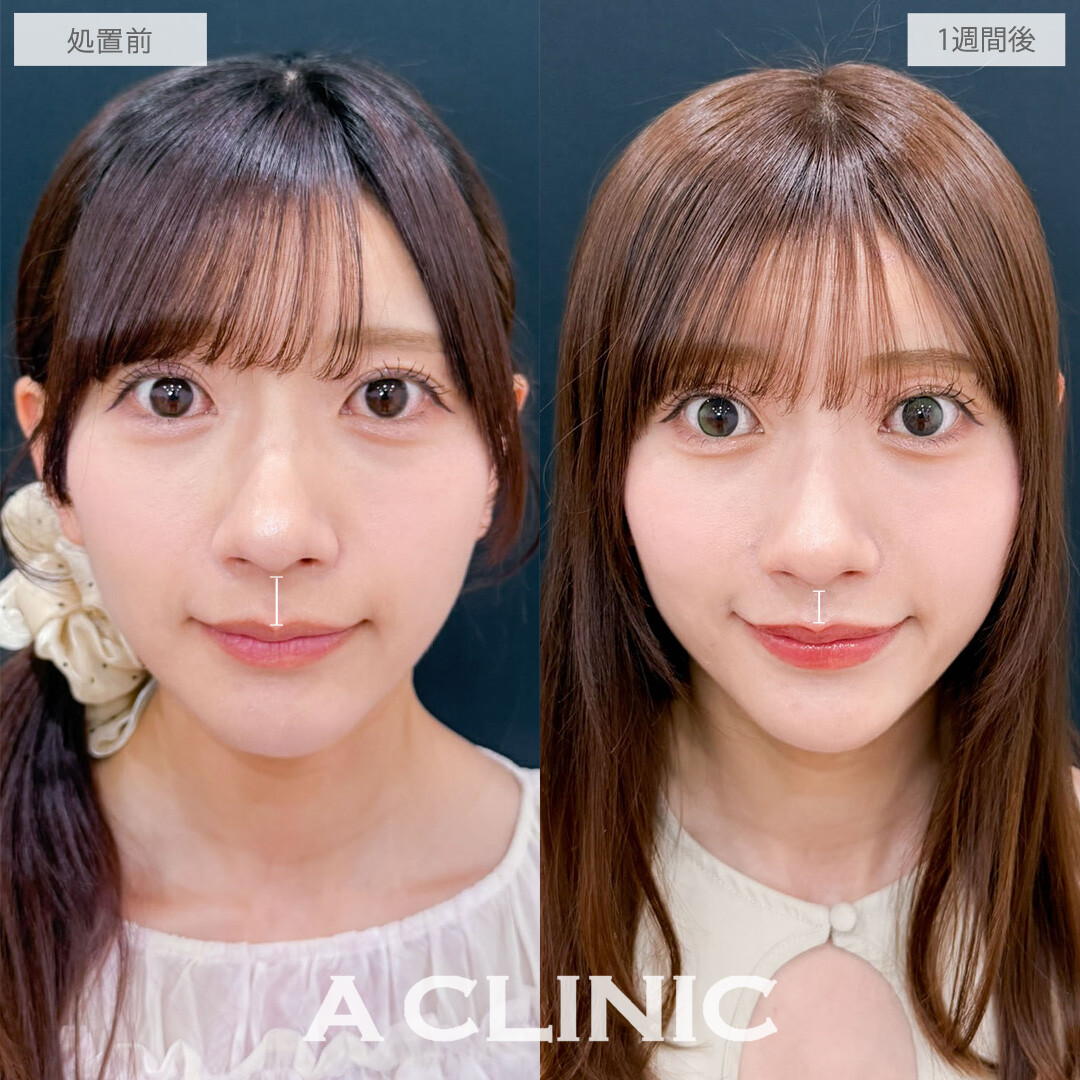 切らない人中短縮(Cカール形成術)で鼻の下をきゅっと縮めて可愛さ爆発！こちら処置前と1週間後の症例です(30代女性)