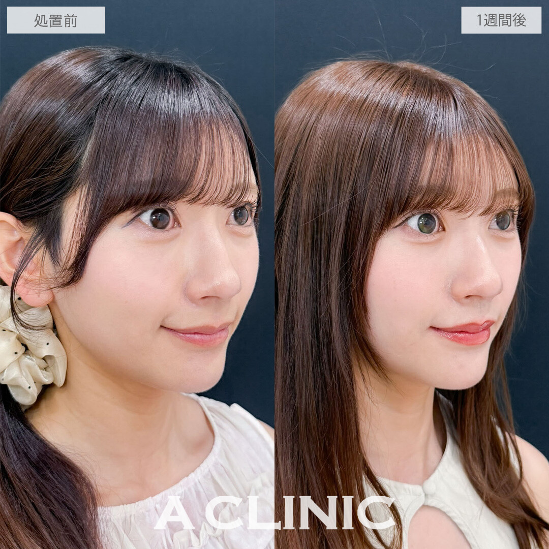 切らない人中短縮(Cカール形成術)で鼻の下をきゅっと縮めて可愛さ爆発！こちら処置前と1週間後の症例です(30代女性)