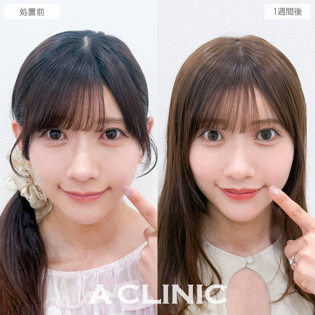 切らない人中短縮(Cカール形成術)で鼻の下をきゅっと縮めて可愛さ爆発！こちら処置前と1週間後の症例です(30代女性)