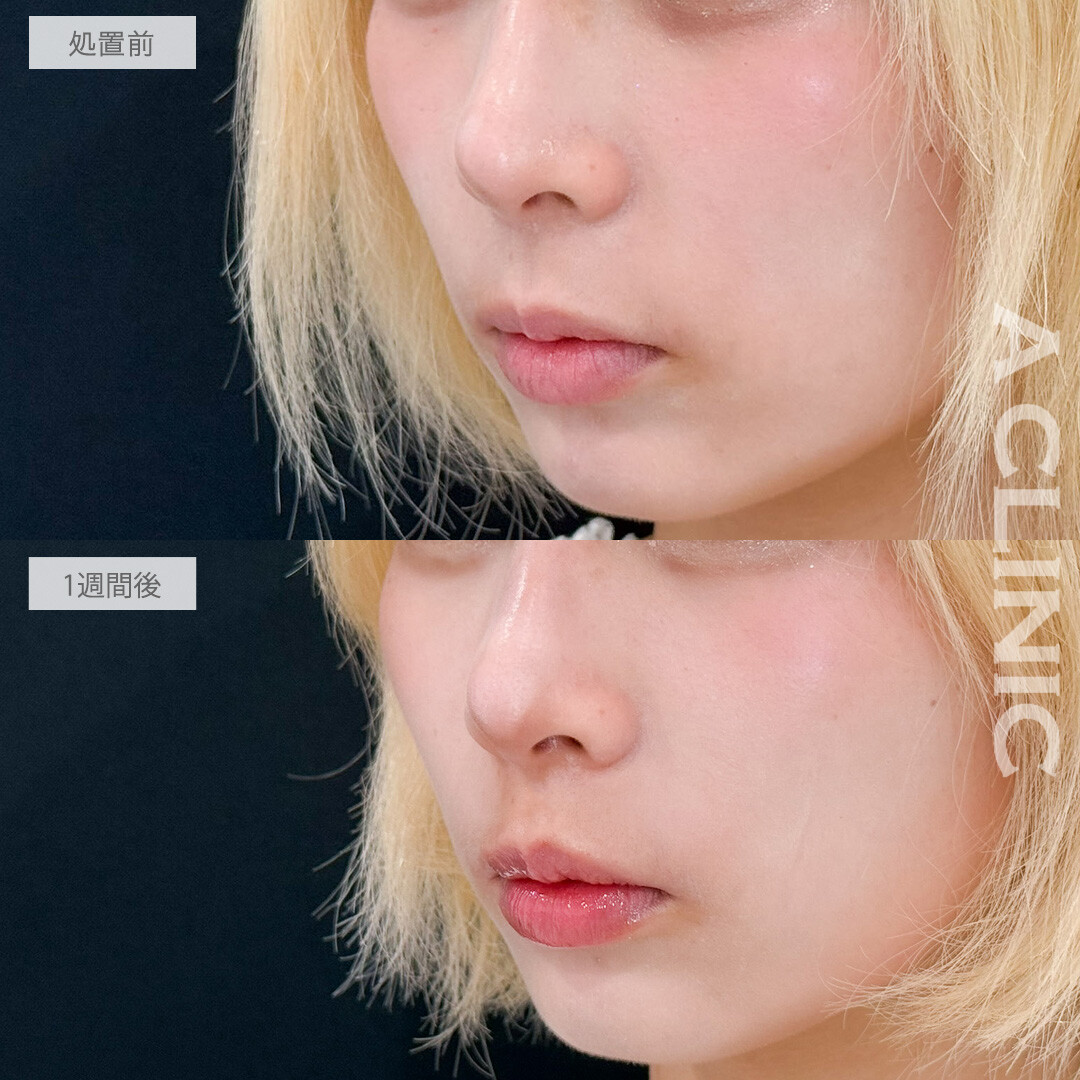 切らない人中短縮(Cカール形成術)は不自然さゼロでツンと上向きの可愛いCカールリップが作れます！こちら処置前と1週間後の症例です(20代女性)