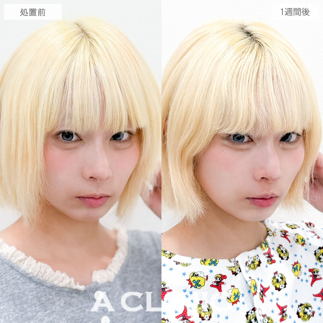 切らない人中短縮(Cカール形成術)は不自然さゼロでツンと上向きの可愛いCカールリップが作れます！こちら処置前と1週間後の症例です(20代女性)