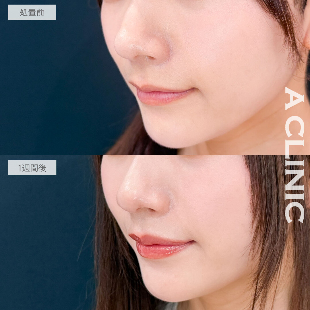 切らない人中短縮(Cカール形成術)で鼻の下をきゅっと縮めて可愛さ爆発！こちら処置前と1週間後の症例です(30代女性)