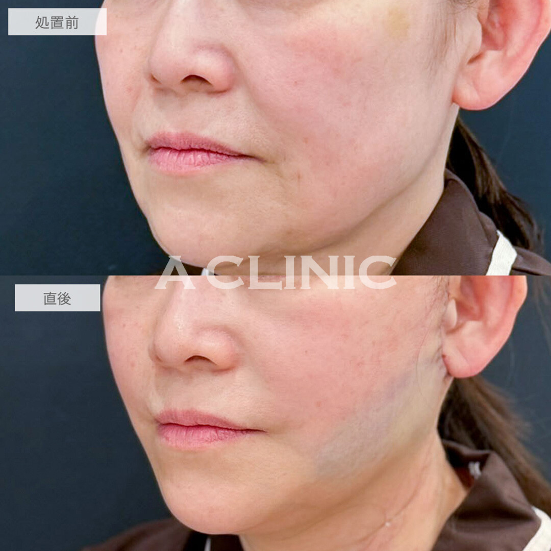 A式たるみ切開と1day小顔脂肪吸引で直後から腫れ少なく若見えフェイスに！処置前と直後の症例です(50代女性)
