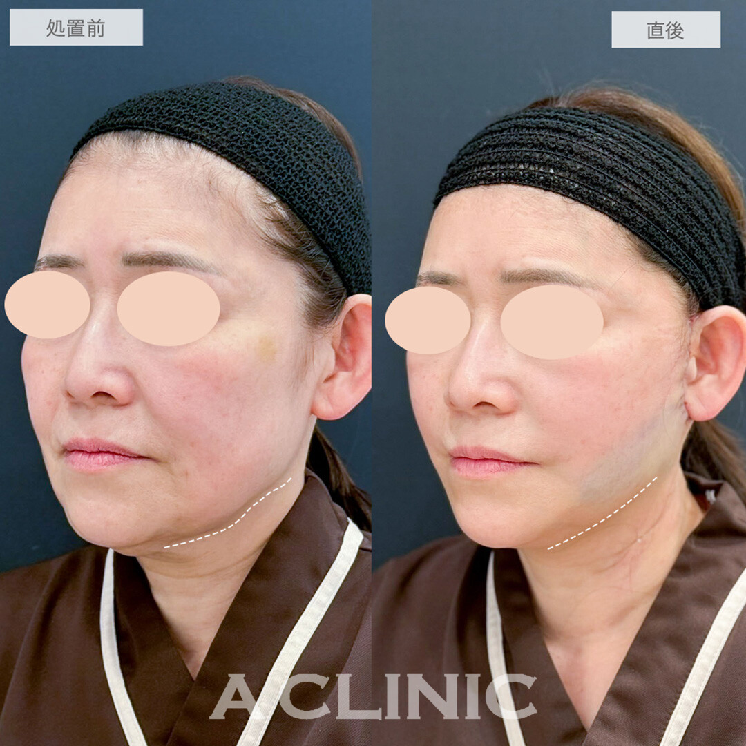 A式たるみ切開と1day小顔脂肪吸引で直後から腫れ少なく若見えフェイスに！処置前と直後の症例です(50代女性)