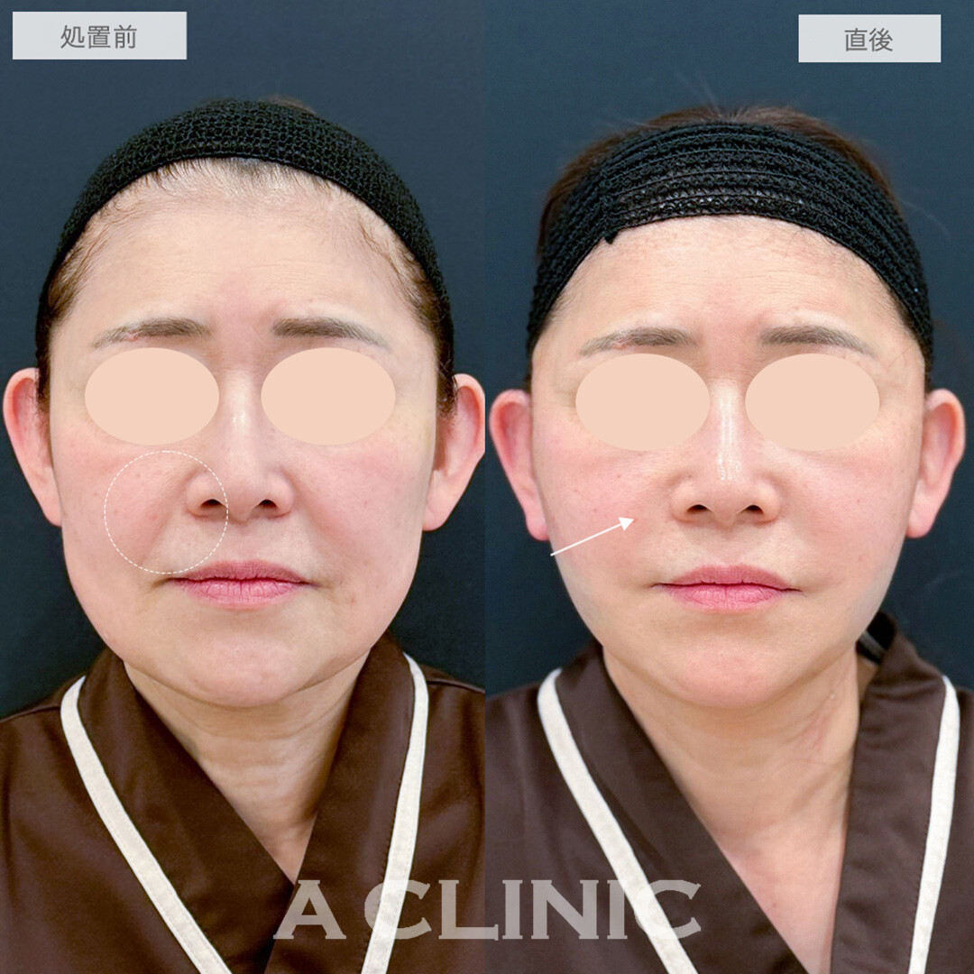 A式たるみ切開と1day小顔脂肪吸引で直後から腫れ少なく若見えフェイスに！処置前と直後の症例です(50代女性)