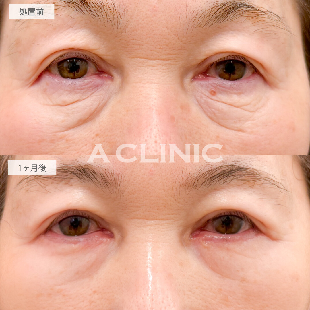 目の下のたるみ取りでスキンケアでは叶わないほどにしわが激減！処置前と1ヶ月後の症例です(60代女性)