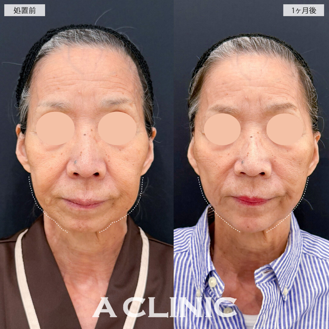 【直後の傷跡あり】A式ナゾラリフトで重心を上げて上品な若々しさを取り戻しマイナス10歳顔へ！こちら処置前と1か月後の症例です(60代女性)