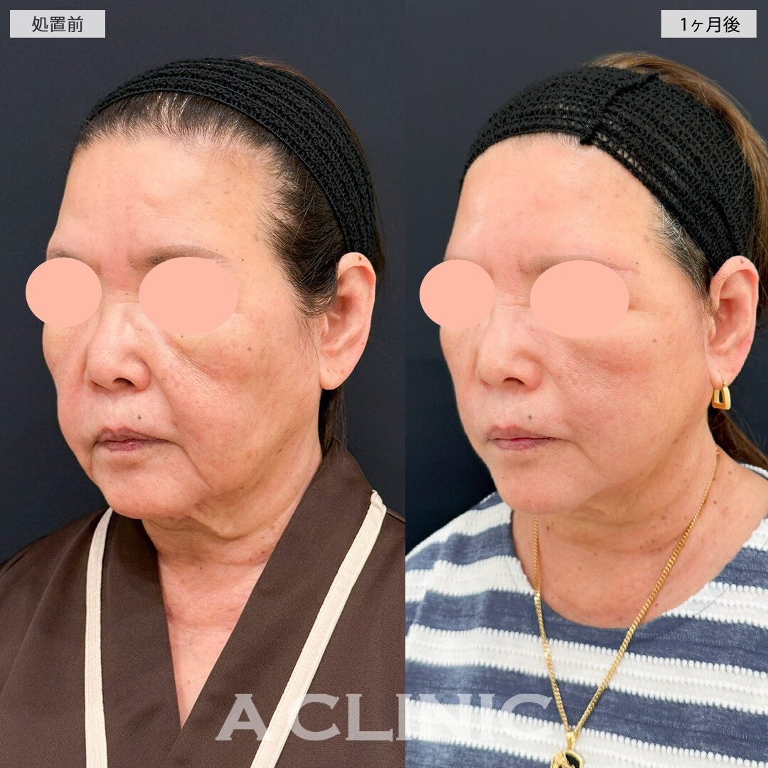 A式ナゾラリフトでたるみの目立たない若々しい姿を取り戻せました！処置前と1ヶ月後の症例です(60代女性)