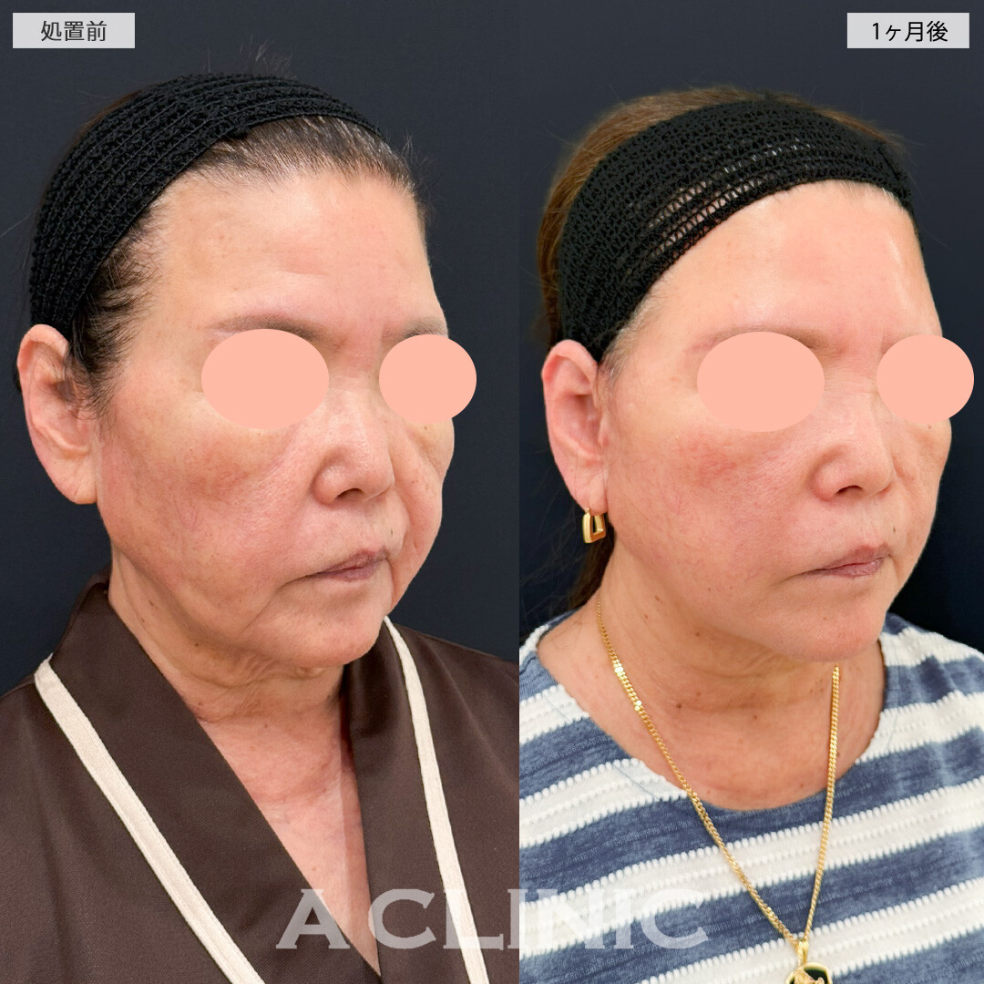 A式ナゾラリフトでたるみの目立たない若々しい姿を取り戻せました！処置前と1ヶ月後の症例です(60代女性)