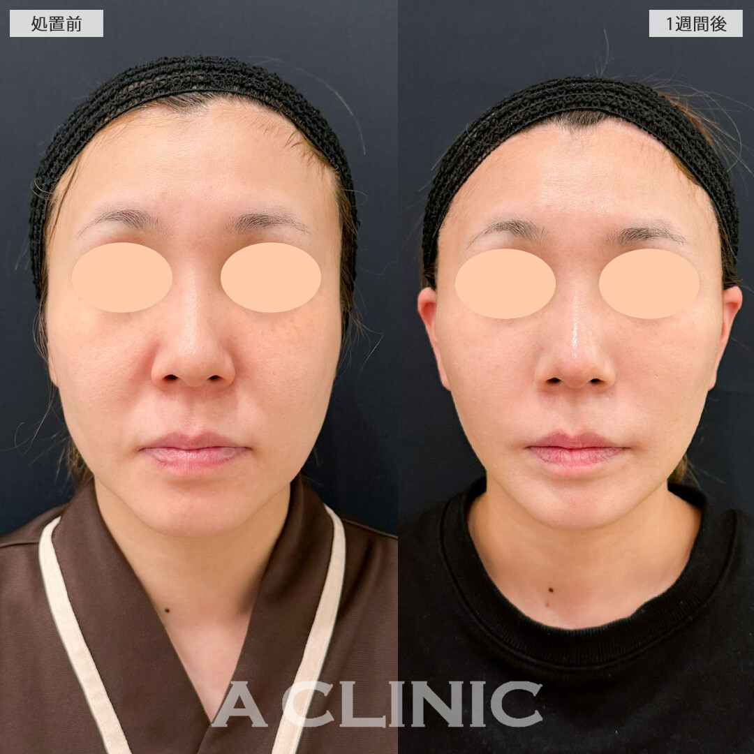A式ナゾラリフトは脂肪除去と切開リフトで一生モノの輪郭を手に入れられる施術です！こちら処置前と1週間後の症例です(30代女性)