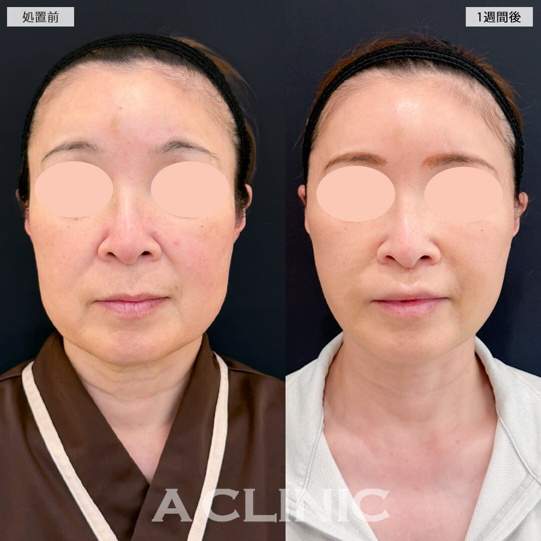 A式ナゾラリフトで垂れてくる脂肪も皮膚もスッキリ解消しこれからのたるみ予防にも！処置前と1週間後の症例です(50代女性)