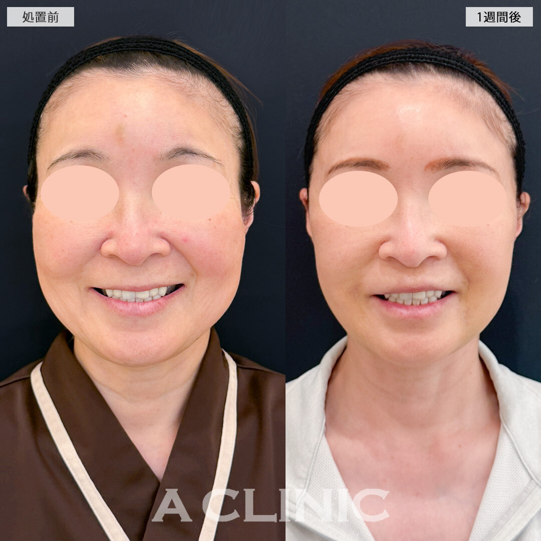 A式ナゾラリフトで垂れてくる脂肪も皮膚もスッキリ解消しこれからのたるみ予防にも！処置前と1週間後の症例です(50代女性)