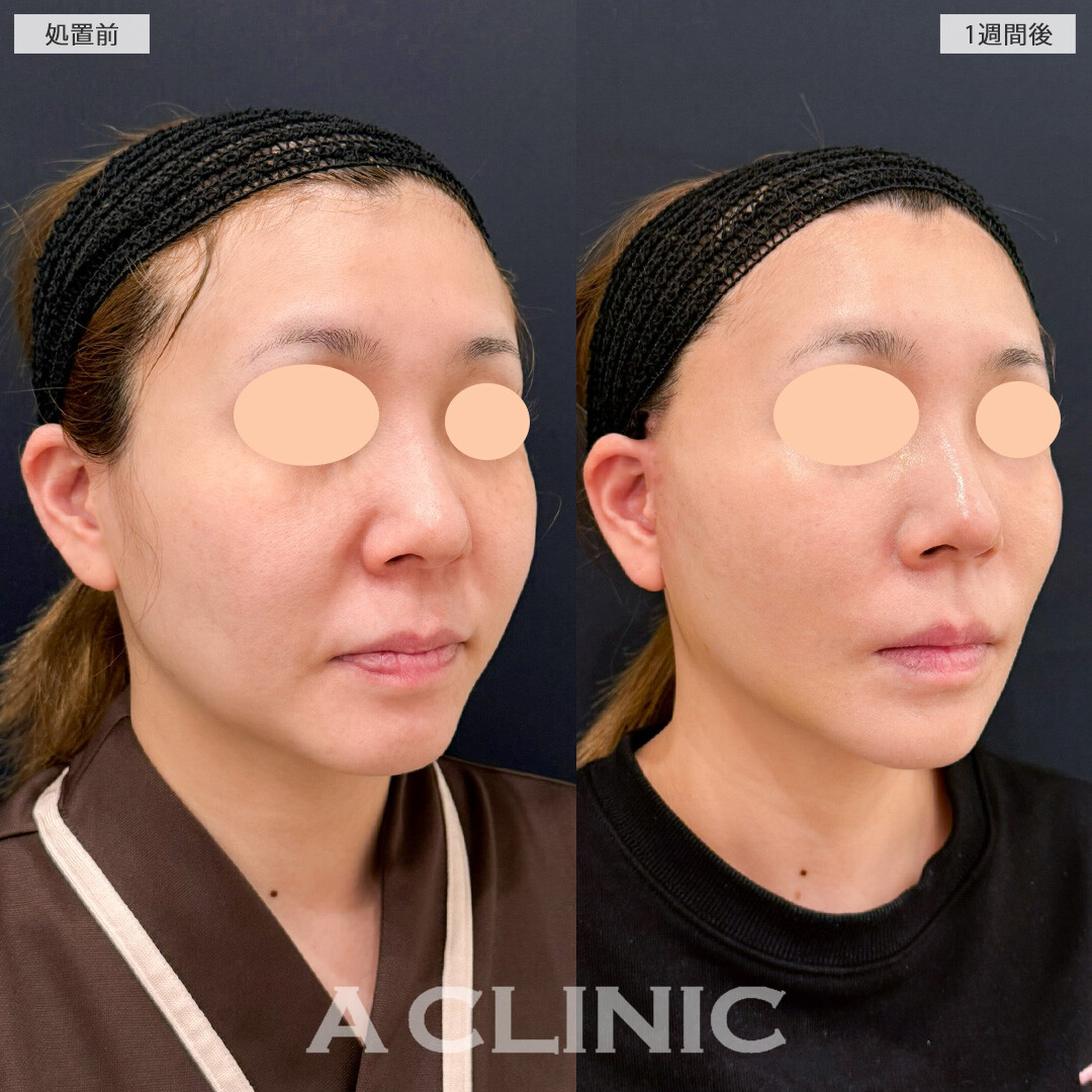 A式ナゾラリフトは脂肪除去と切開リフトで一生モノの輪郭を手に入れられる施術です！こちら処置前と1週間後の症例です(30代女性)