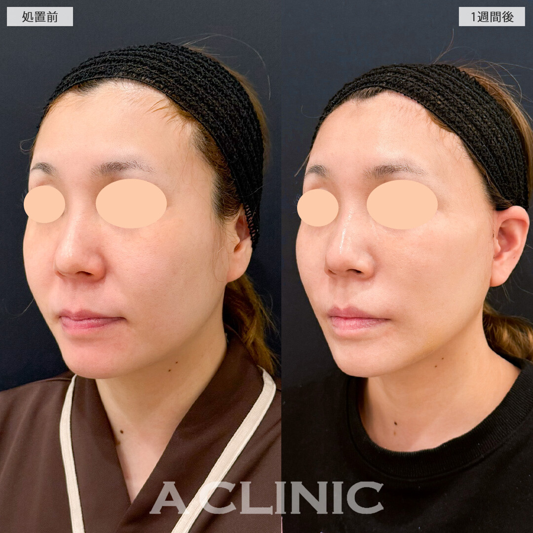 A式ナゾラリフトは脂肪除去と切開リフトで一生モノの輪郭を手に入れられる施術です！こちら処置前と1週間後の症例です(30代女性)