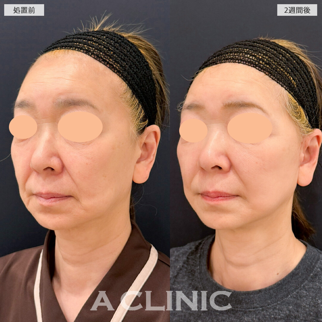 A式たるみ切開は50代のための本格フェイスリフトです！こちら処置前と2週間後の症例です(50代女性)