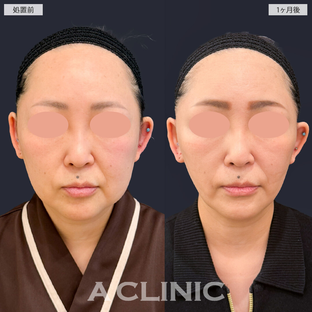 【直後の傷跡あり】1day小顔脂肪吸引とA式たるみ切開で余分な脂肪とたるみを一気に除去！こちら処置前と1か月後の症例です(40代女性)