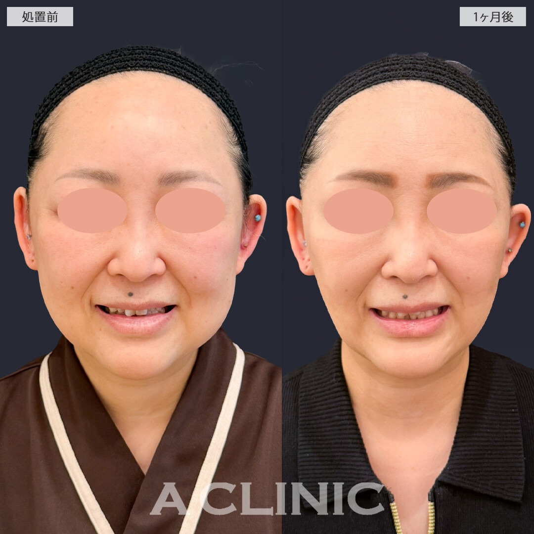 【直後の傷跡あり】1day小顔脂肪吸引とA式たるみ切開で余分な脂肪とたるみを一気に除去！こちら処置前と1か月後の症例です(40代女性)