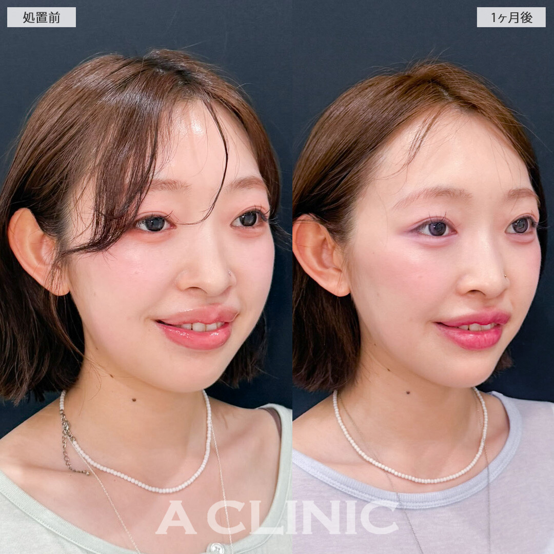 1day小顔脂肪吸引は元から小顔さんの魅力を最大化できる施術です！こちら処置前と1か月後の症例です(20代女性)
