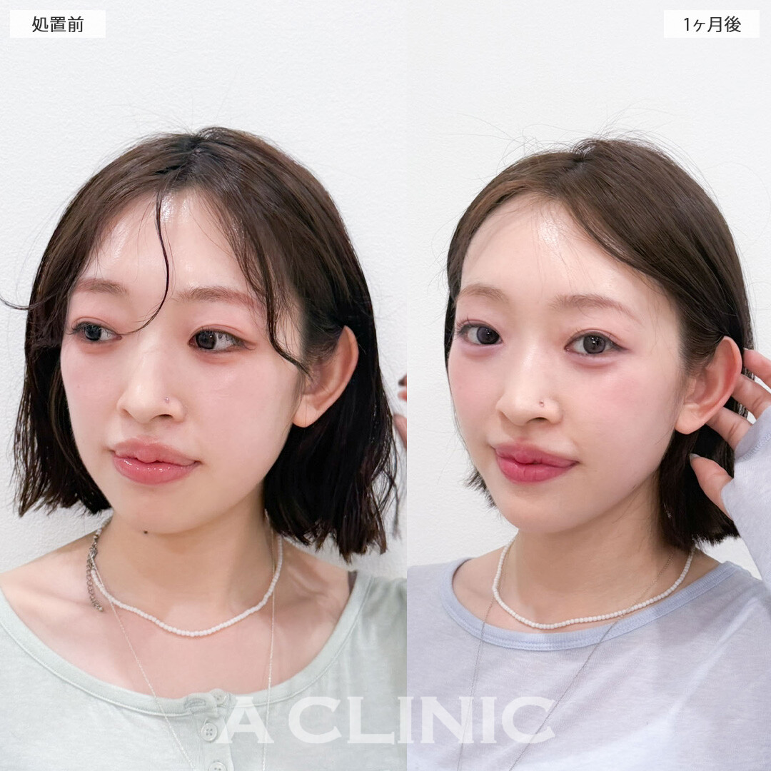 1day小顔脂肪吸引は元から小顔さんの魅力を最大化できる施術です！こちら処置前と1か月後の症例です(20代女性)