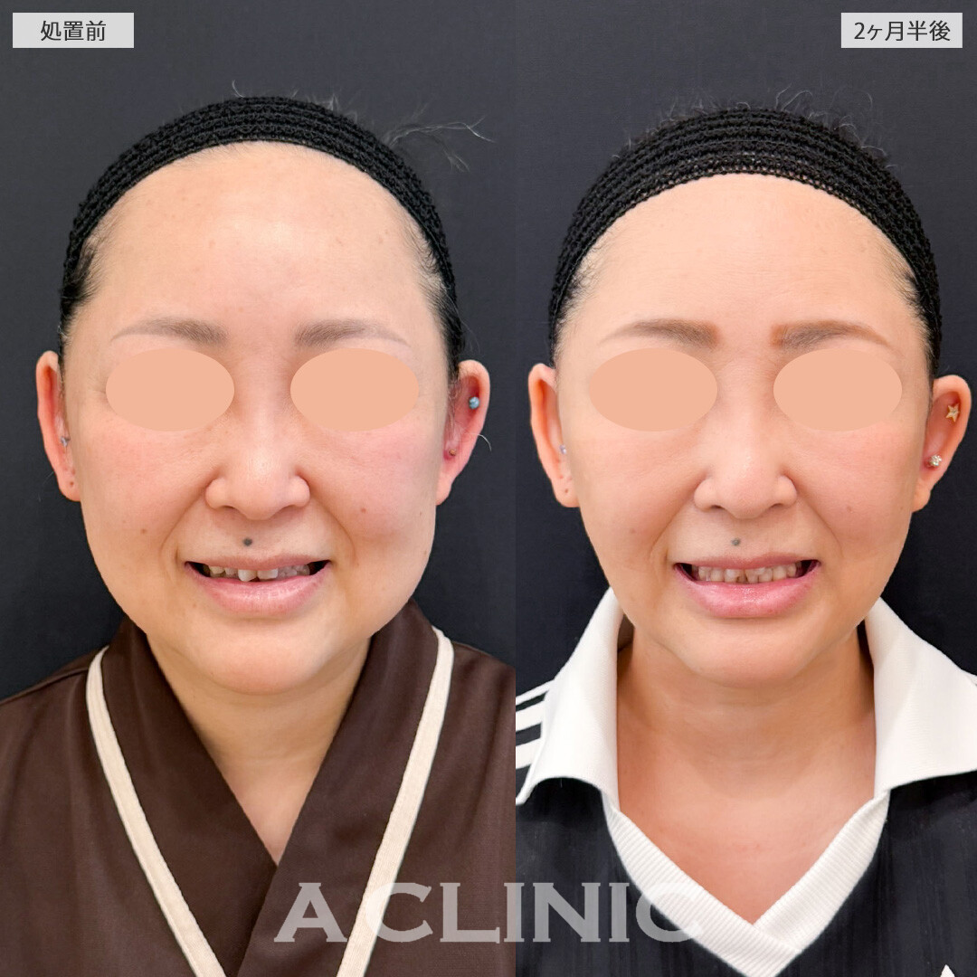 1day小顔脂肪吸引とA式たるみ切開で時を巻き戻したかのような究極の若返り！こちら処置前と2ヶ月半後の症例です(40代女性)