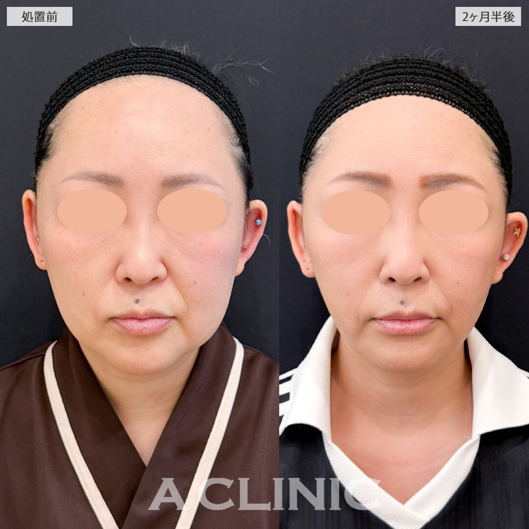1day小顔脂肪吸引とA式たるみ切開で時を巻き戻したかのような究極の若返り！こちら処置前と2ヶ月半後の症例です(40代女性)