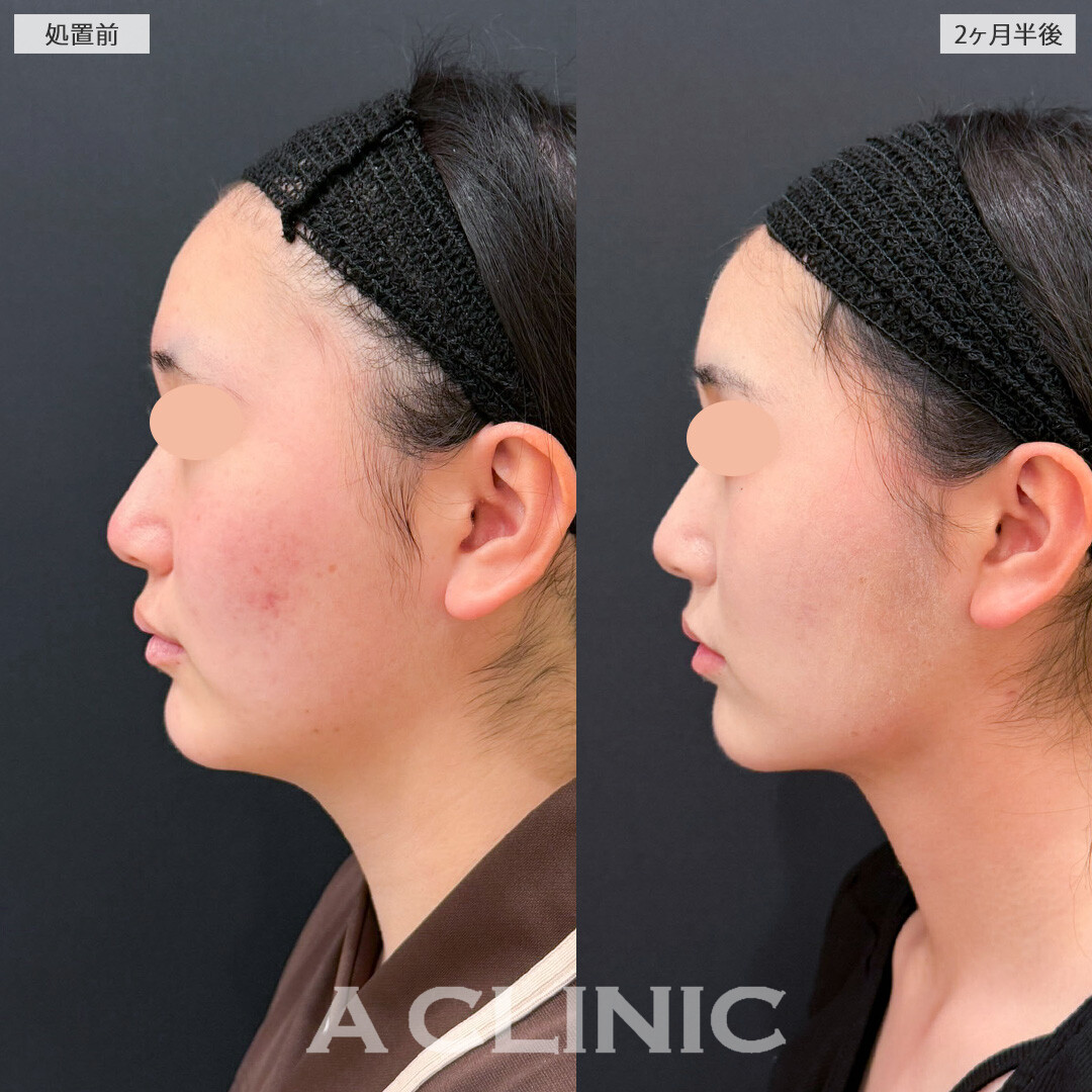 1day小顔脂肪吸引であご下の脂肪をメインに全方位の肉感をすっきり落としました！こちら処置前と2ヶ月半後の症例です(10代女性)