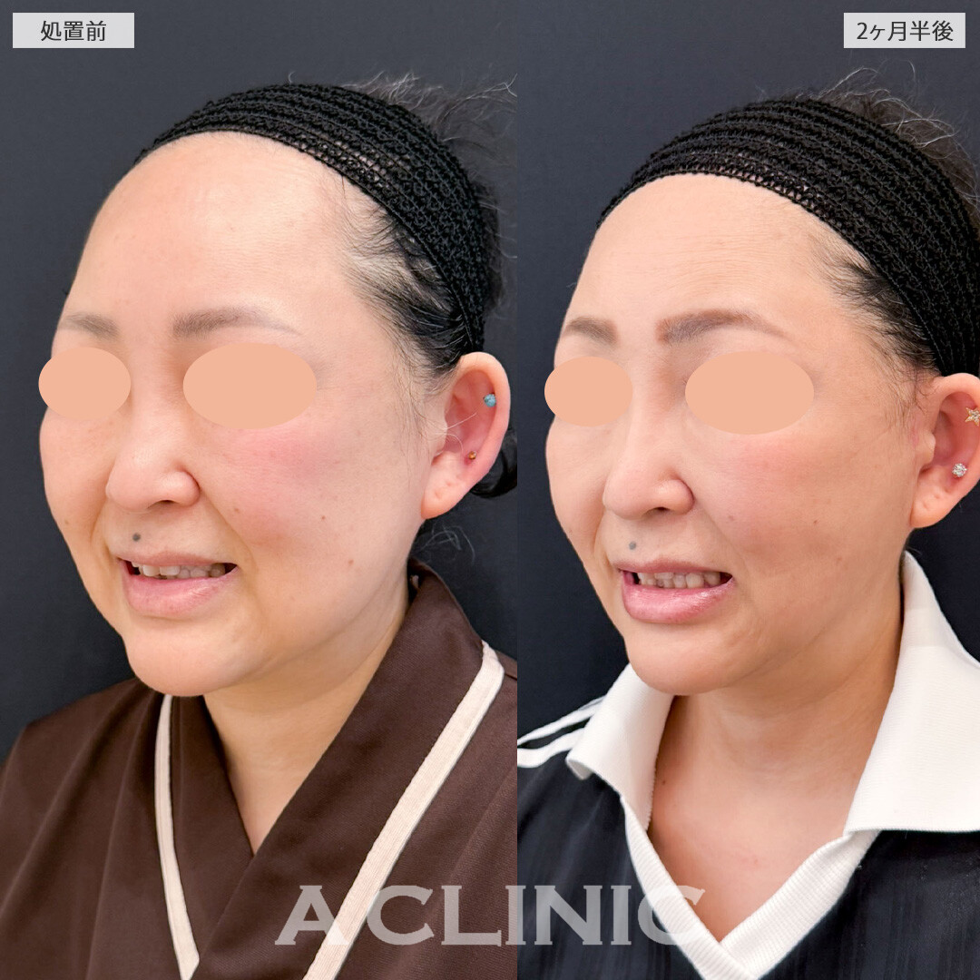 1day小顔脂肪吸引とA式たるみ切開で時を巻き戻したかのような究極の若返り！こちら処置前と2ヶ月半後の症例です(40代女性)