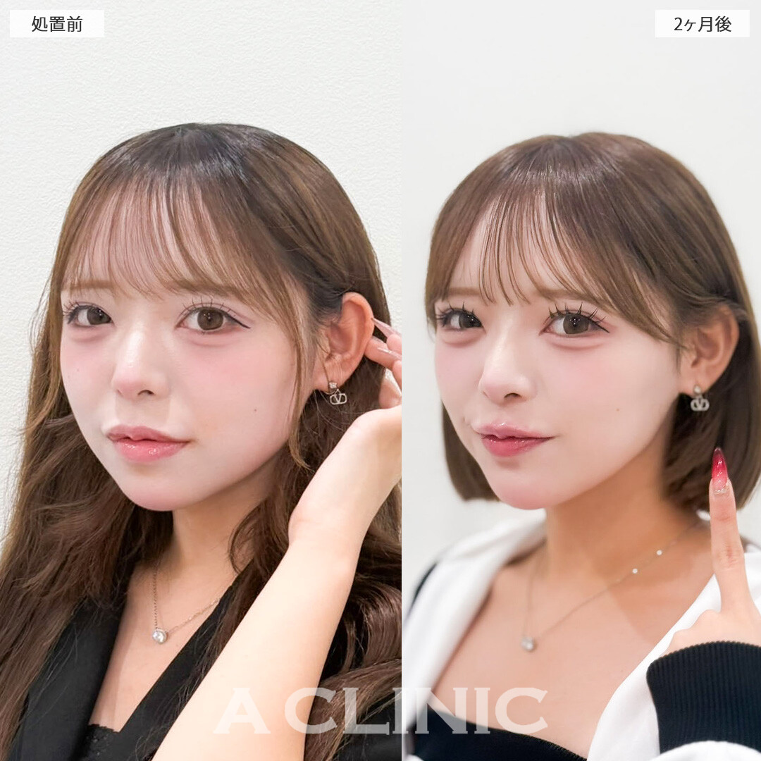 1day小顔脂肪吸引とあごへのヒアルロン酸注入で左右のバランスを整えながら顔の余白を最小限に抑え垢抜け！こちら処置前と2ヶ月後の症例です(10代女性)