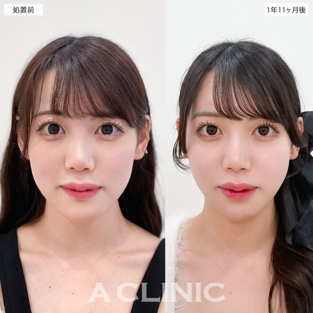 1day小顔脂肪吸引で完璧な小顔になって加工卒業！こちら処置前と1年11か月後の症例です(20代女性)