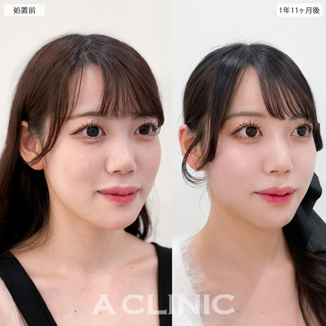1day小顔脂肪吸引で完璧な小顔になって加工卒業！こちら処置前と1年11か月後の症例です(20代女性)