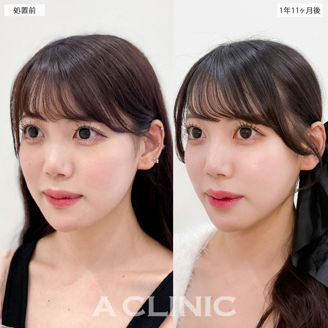 1day小顔脂肪吸引で完璧な小顔になって加工卒業！こちら処置前と1年11か月後の症例です(20代女性)