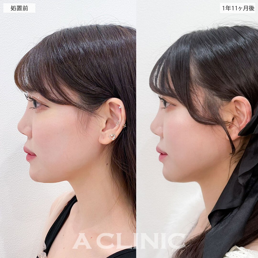 1day小顔脂肪吸引で完璧な小顔になって加工卒業！こちら処置前と1年11か月後の症例です(20代女性)