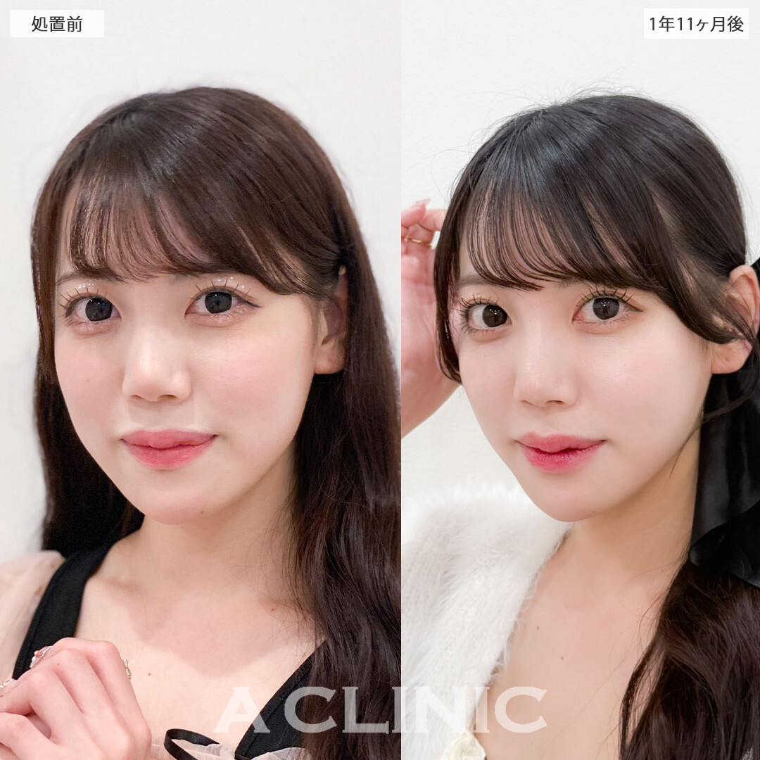 1day小顔脂肪吸引で完璧な小顔になって加工卒業！こちら処置前と1年11か月後の症例です(20代女性)