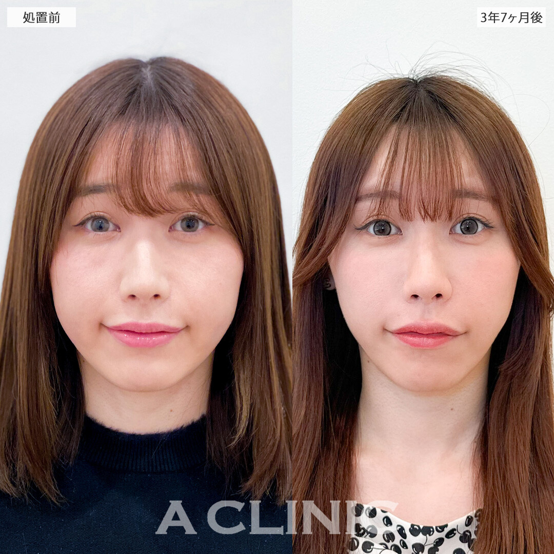 1day小顔脂肪吸引は月日が流れても美しく整ったまま！こちら処置前と3年7ヶ月後の症例です(20代女性)