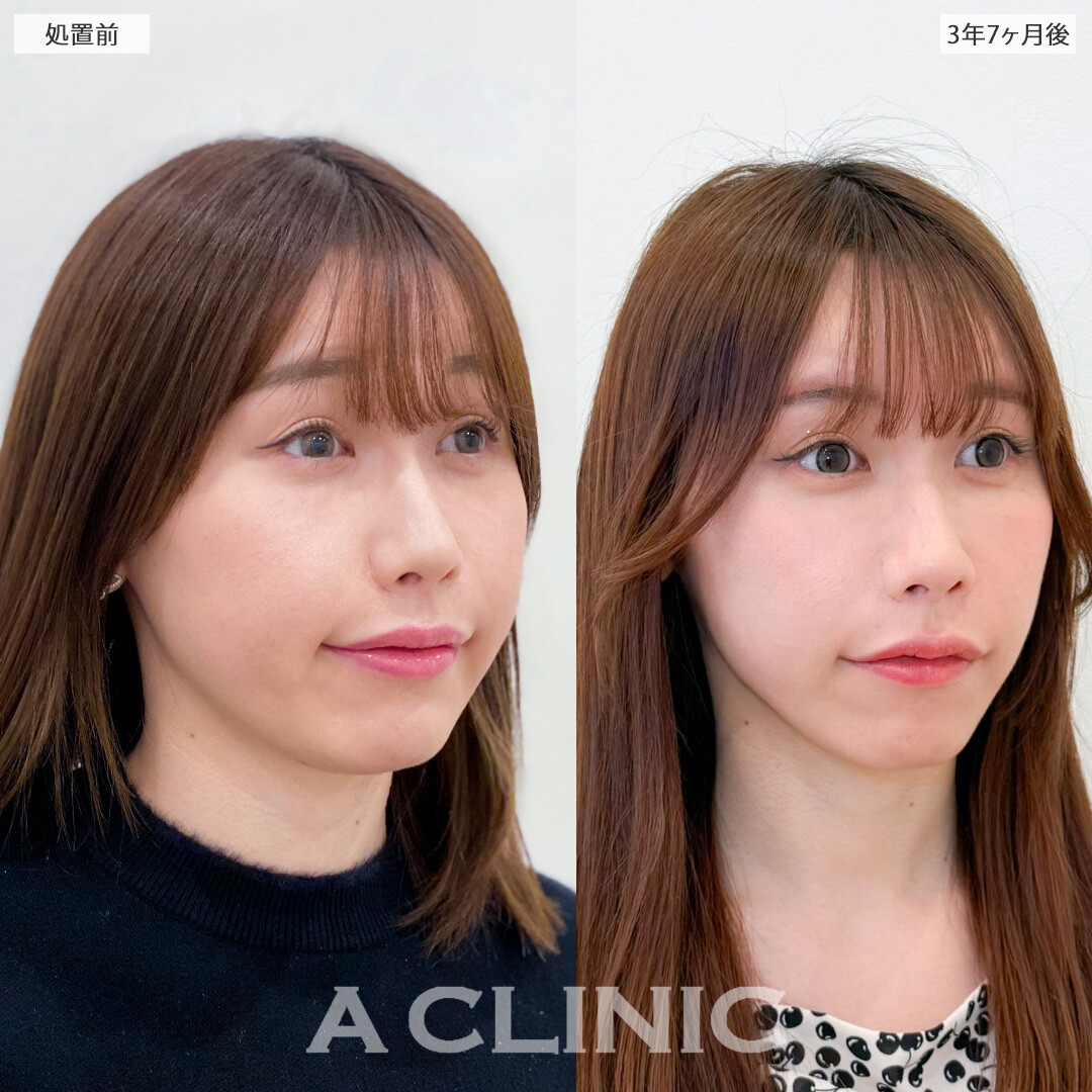 1day小顔脂肪吸引は月日が流れても美しく整ったまま！こちら処置前と3年7ヶ月後の症例です(20代女性)