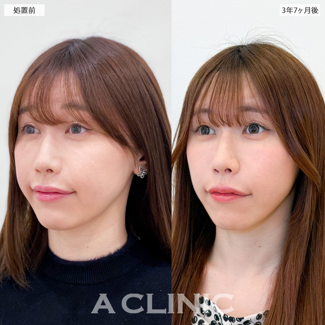 1day小顔脂肪吸引は月日が流れても美しく整ったまま！こちら処置前と3年7ヶ月後の症例です(20代女性)