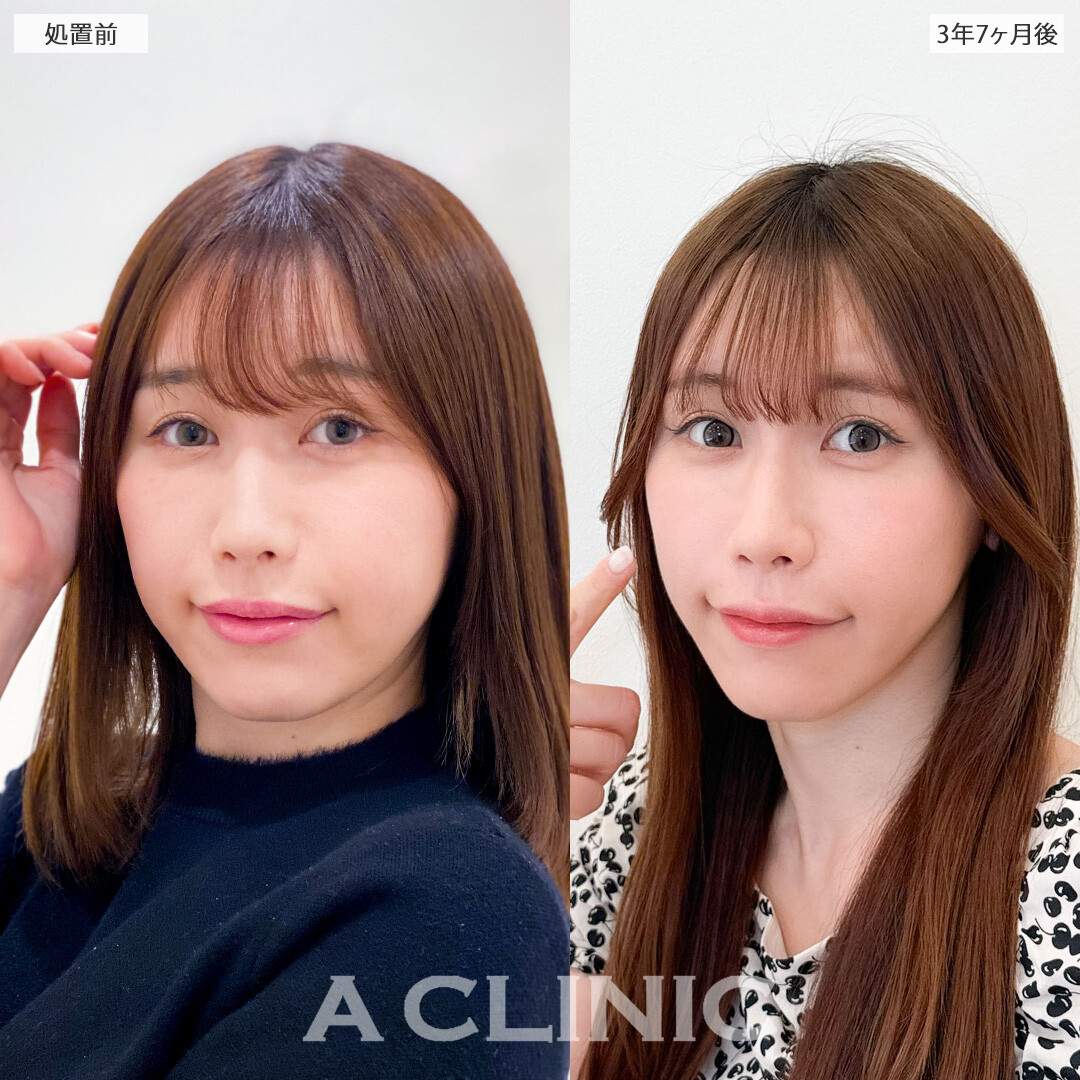 1day小顔脂肪吸引は月日が流れても美しく整ったまま！こちら処置前と3年7ヶ月後の症例です(20代女性)