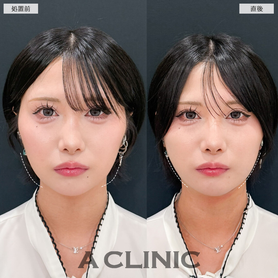 1day小顔脂肪吸引は直後からシャープさを実感できる施術です！こちら処置前と直後の症例です(20代女性)