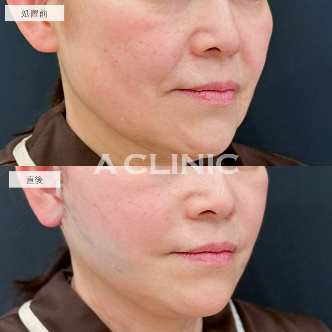 A式たるみ切開と1day小顔脂肪吸引で直後から腫れ少なく若見えフェイスに！処置前と直後の症例です(50代女性)