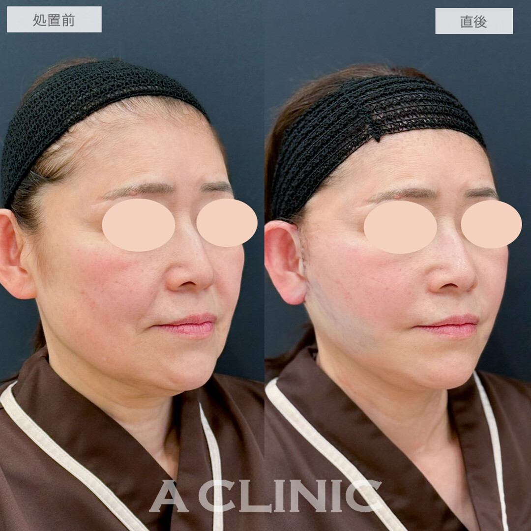 A式たるみ切開と1day小顔脂肪吸引で直後から腫れ少なく若見えフェイスに！処置前と直後の症例です(50代女性)