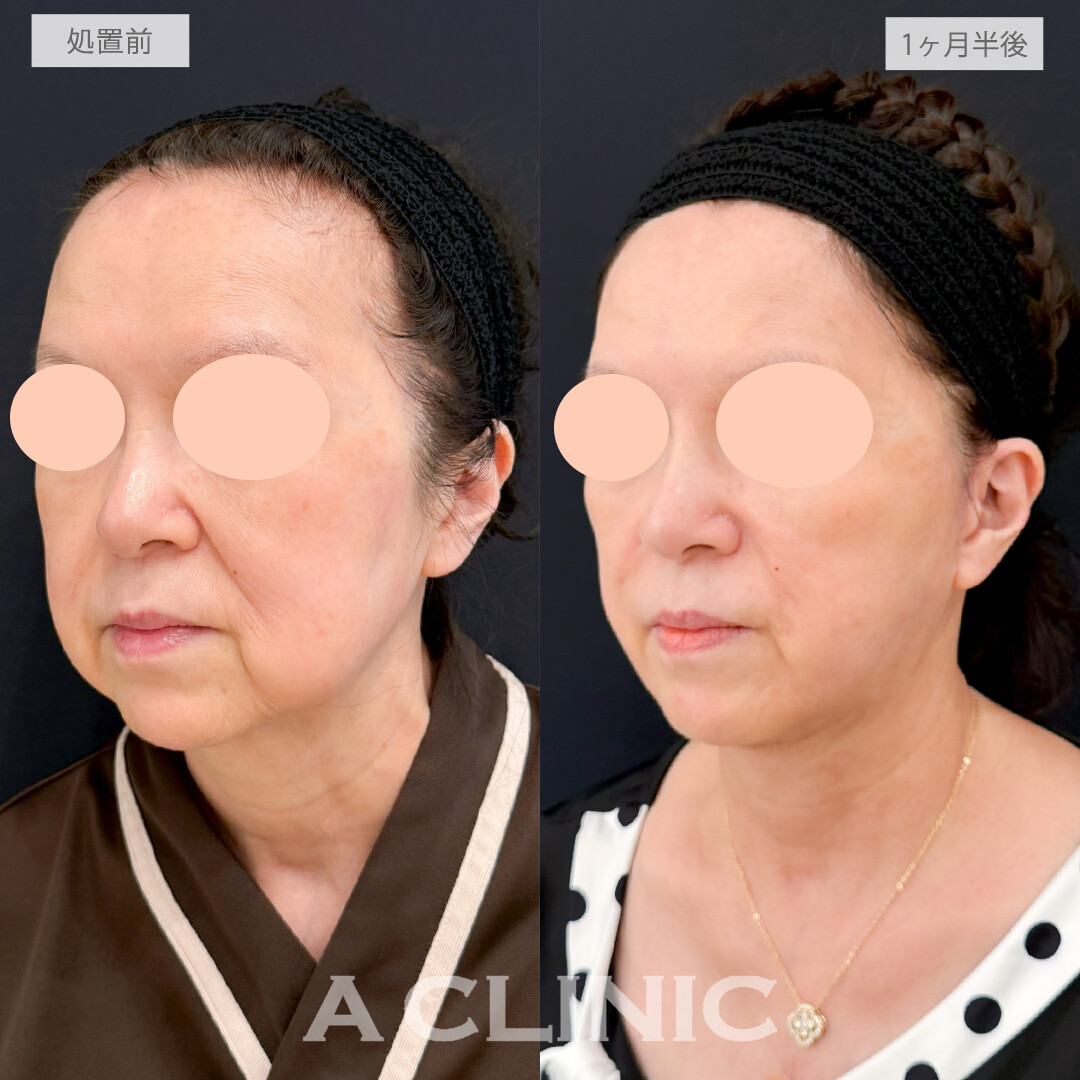 A式ナゾラリフトとバッカルファット除去術で垂れてくる脂肪を徹底除去！処置前と1ヶ月半後の症例です(70代女性)