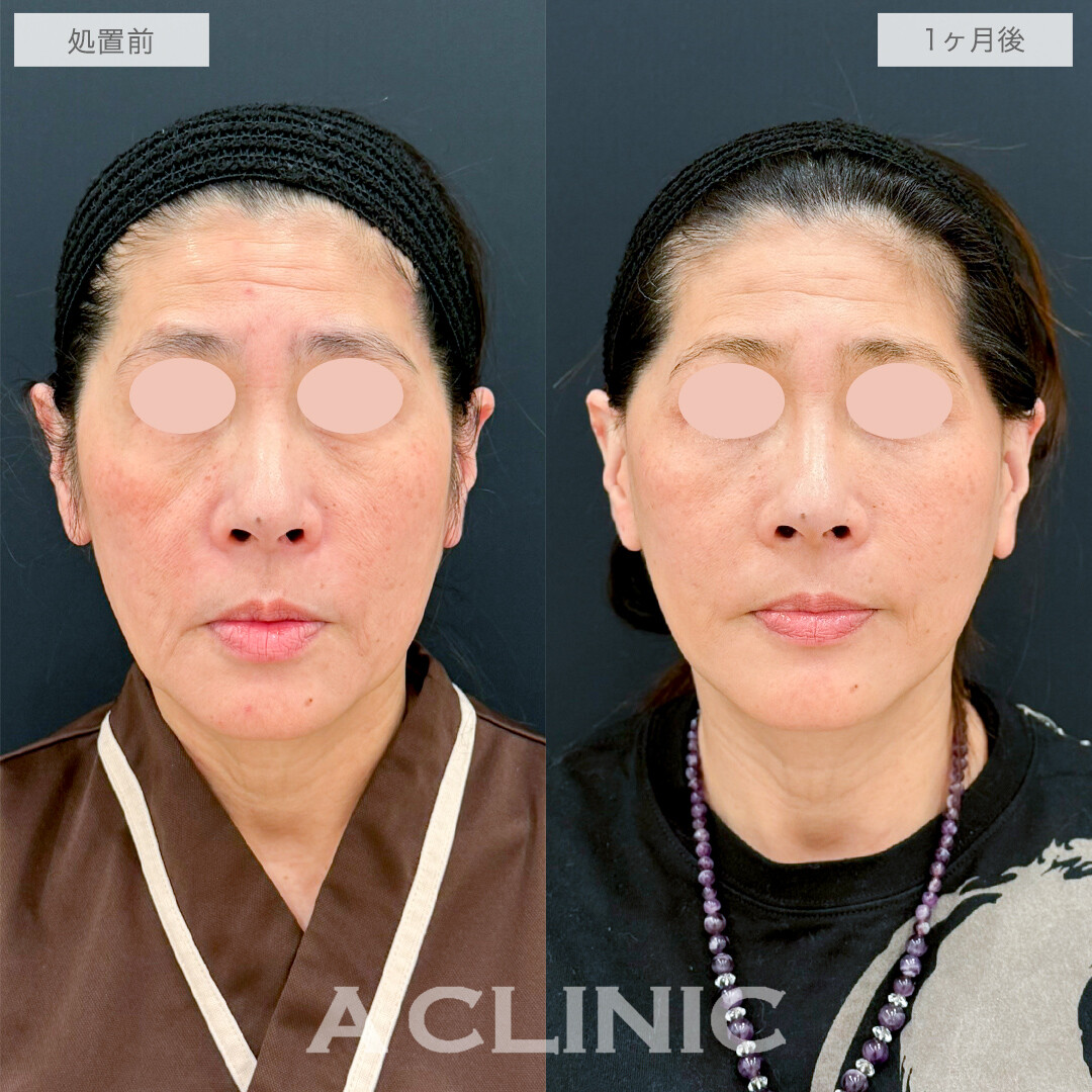 A式たるみ切開とゴルゴラインへのヒアルロン酸注射で若返り効果抜群！処置前と1ヶ月後の症例です(50代女性)