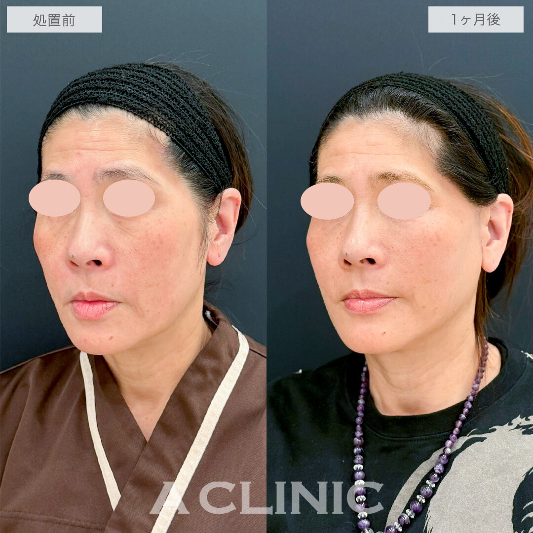 A式たるみ切開とゴルゴラインへのヒアルロン酸注射で若返り効果抜群！処置前と1ヶ月後の症例です(50代女性)