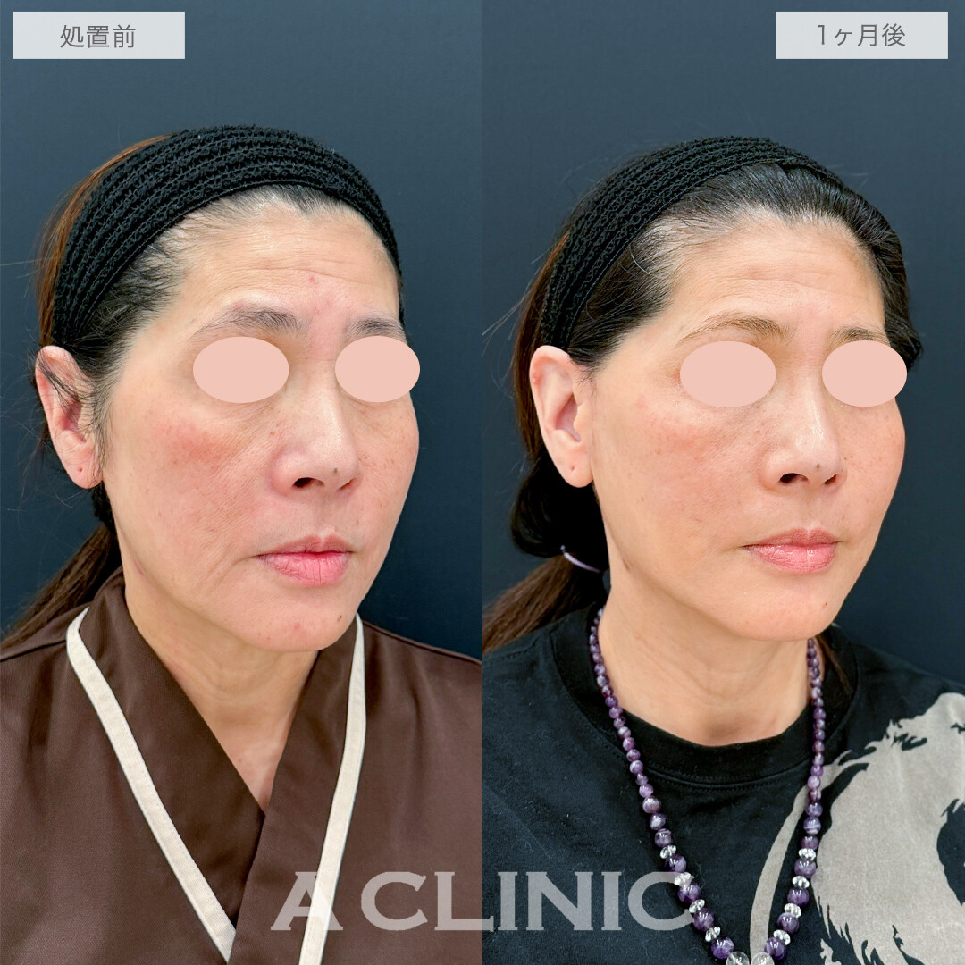 A式たるみ切開とゴルゴラインへのヒアルロン酸注射で若返り効果抜群！処置前と1ヶ月後の症例です(50代女性)