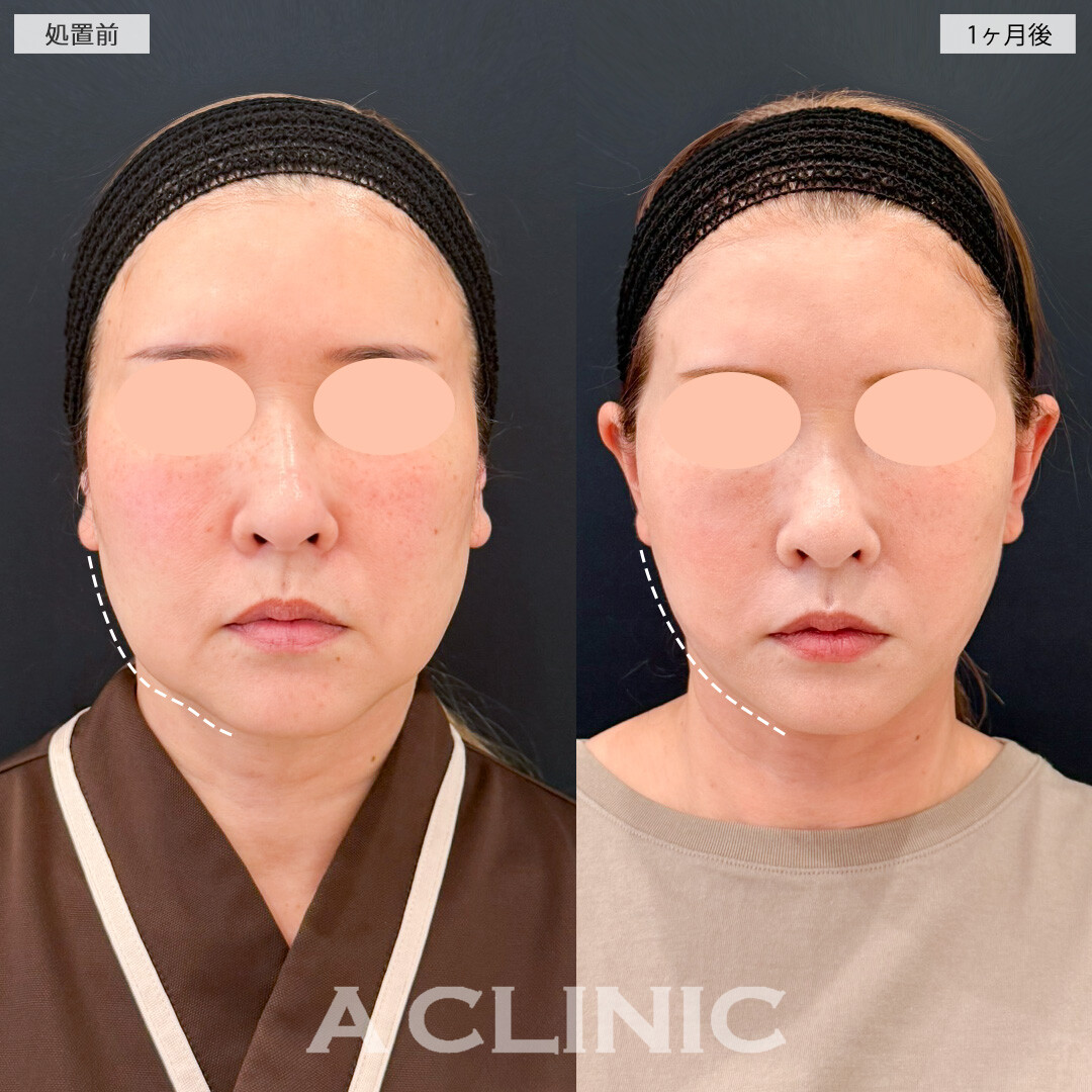 1day小顔脂肪吸引とA式たるみ切開で垂れやすい脂肪も皮膚もスッキリ！処置前と1ヶ月後の症例です(50代女性)
