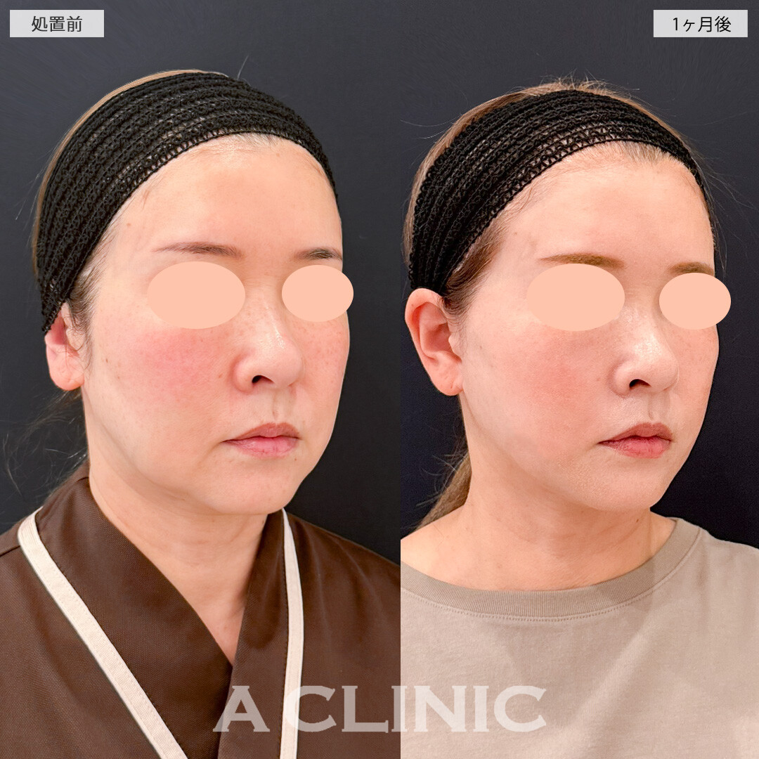 1day小顔脂肪吸引とA式たるみ切開で垂れやすい脂肪も皮膚もスッキリ！処置前と1ヶ月後の症例です(50代女性)