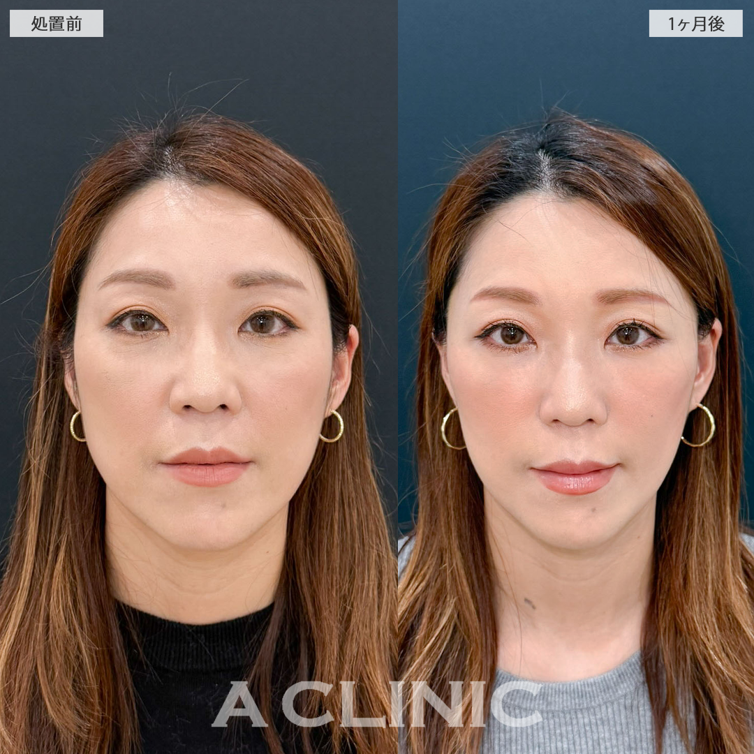 【直後の傷跡あり】1day小顔脂肪吸引とA式たるみ切開でお顔の余白が減り他のパーツが際立ちます！こちら処置前と一ヶ月後の症例です(40代女性)