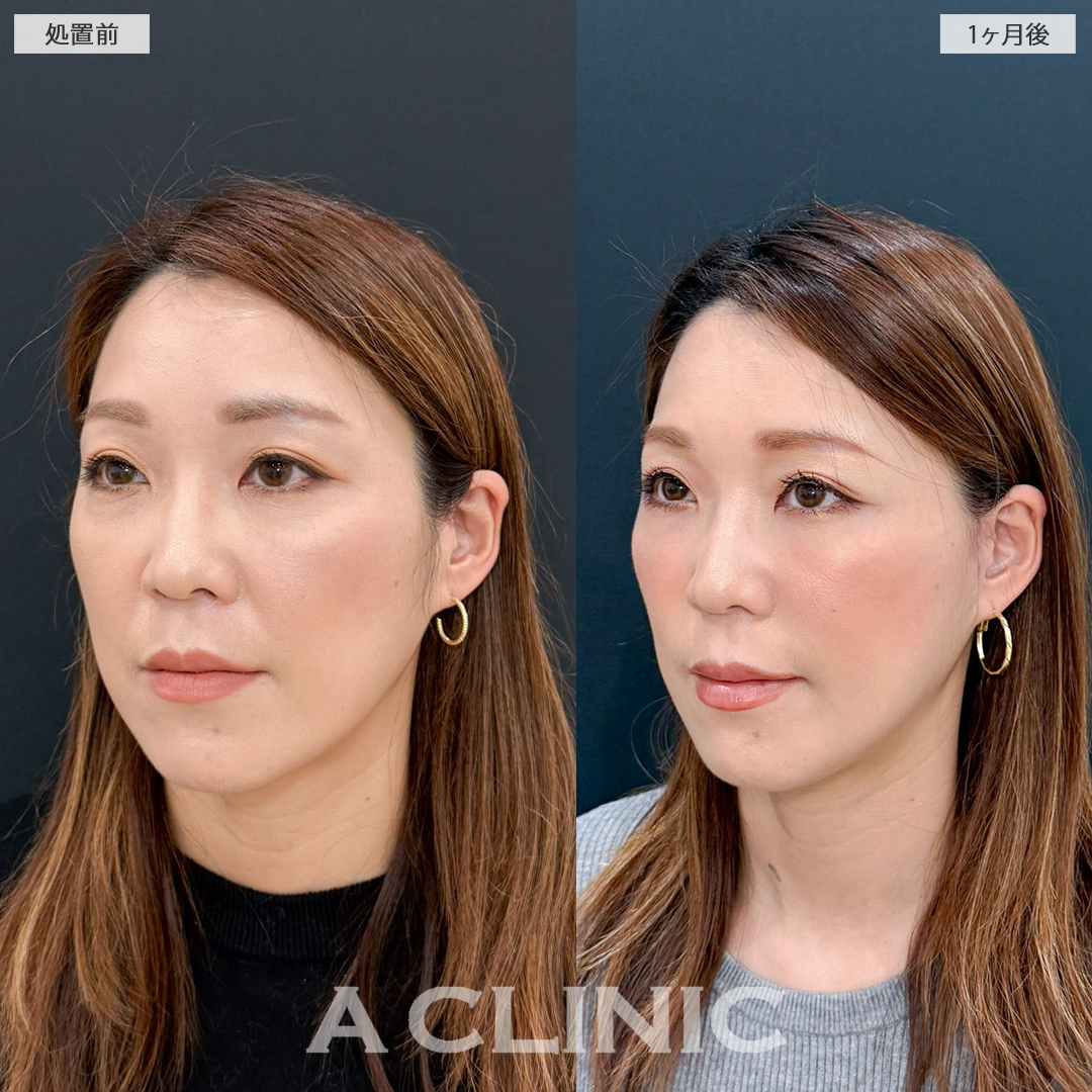 【直後の傷跡あり】1day小顔脂肪吸引とA式たるみ切開でお顔の余白が減り他のパーツが際立ちます！こちら処置前と一ヶ月後の症例です(40代女性)